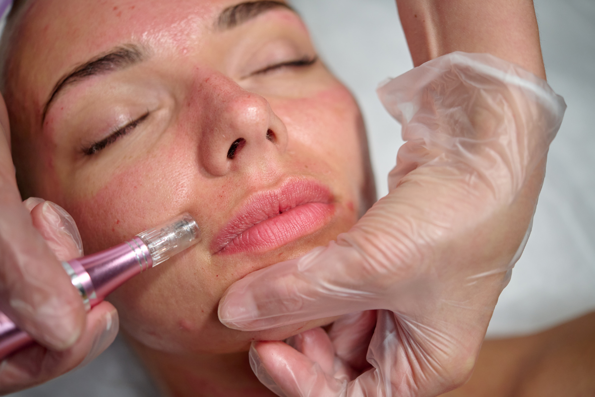 Microneedling after Consultation